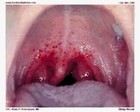strep throat